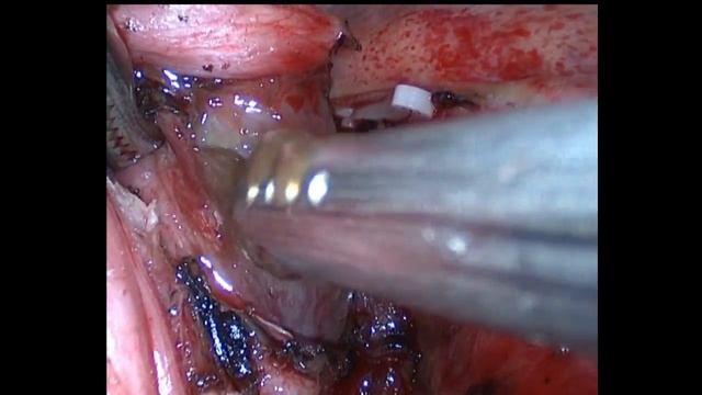 Удаление бронхиальной кисты. Торакоскопия. Removal of bronchial cyst смотреть онлайн