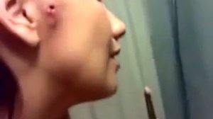 ЛИЧИНКА ОВОДА В ЩЕКЕ У ДЕВУШКИ.......... 18+