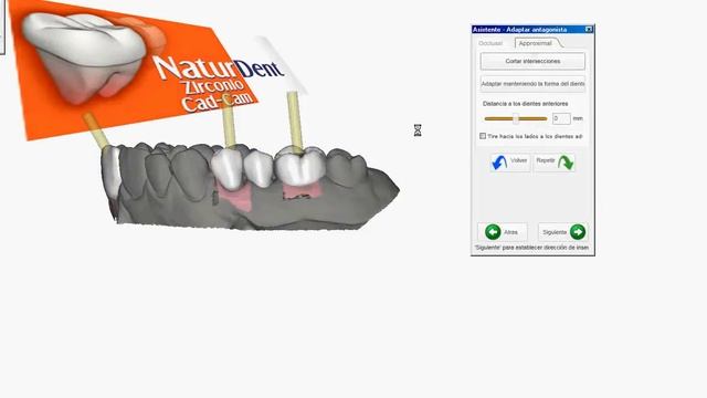 Cad cam dental Exocad Naturdent software de implantes смотреть онлайн