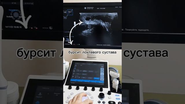 УЗИ МЯГКИХ ТКАНЕЙ ОБЛАСТИ ЛОКТЕВОГО СУСТАВА смотреть онлайн