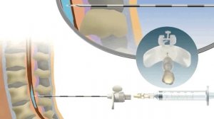 Техника постановки эпидурального катетера