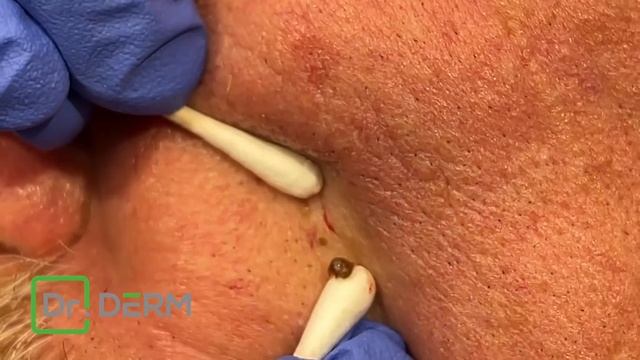 Birds Nest Blackhead | Dr. Derm смотреть онлайн