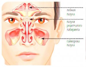 Как промыть нос при обострении гайморита