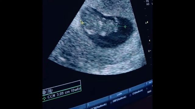 Ultrassom do 1 trimestre garante idade gestacional смотреть онлайн