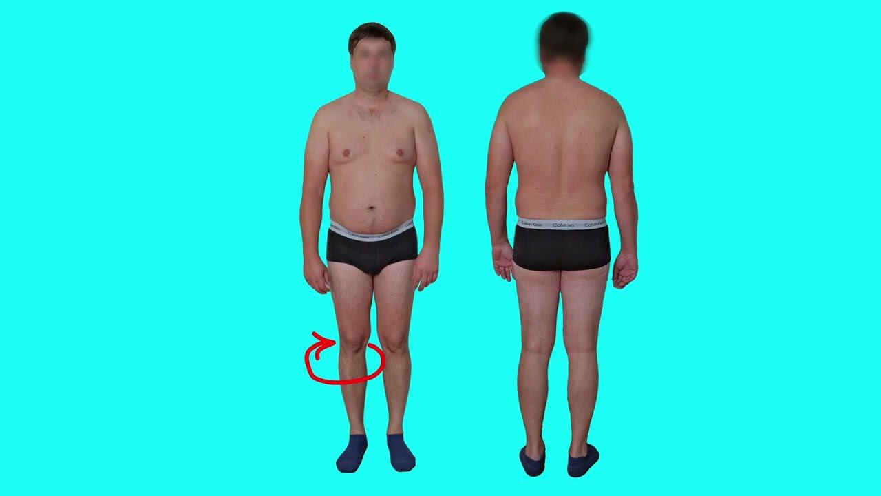 Кифоз. Разбор осанки.