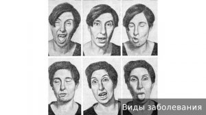 Хорея. Как лечить хорею.