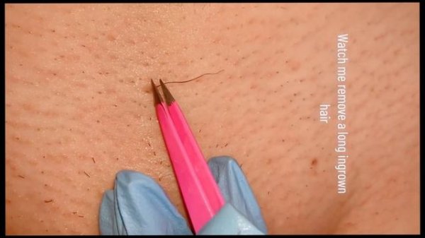 Вросшие волос | Вросший волос под кожу | Ingrown hair under the skin