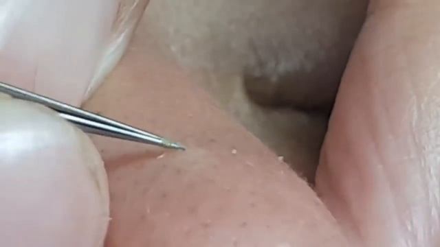 расширенные поры на носу смотреть онлайн