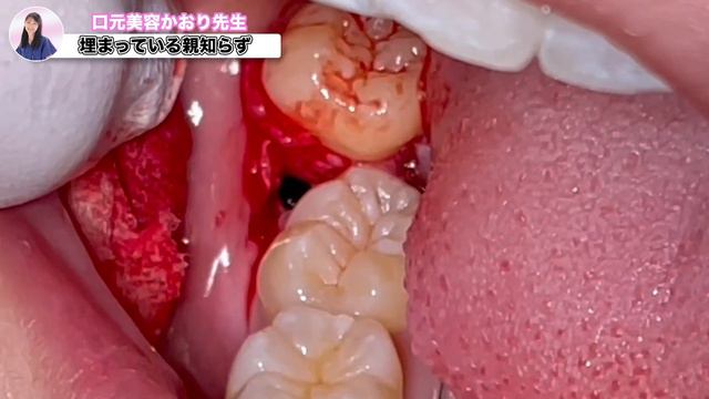 埋まった親知らず引っこ抜く！膿む前でよかったね♪ смотреть онлайн