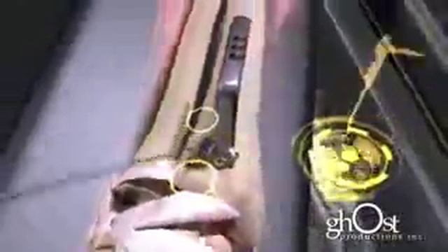 Жесткие травмы