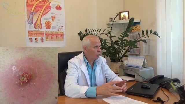 Диагностика фурункулеза смотреть онлайн
