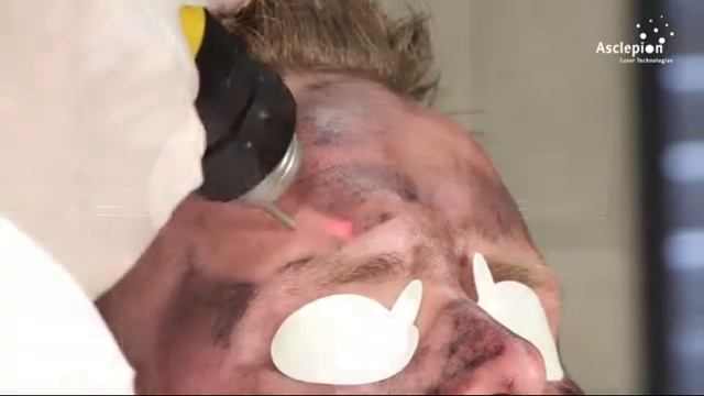 TattooStar carbon peeling смотреть онлайн