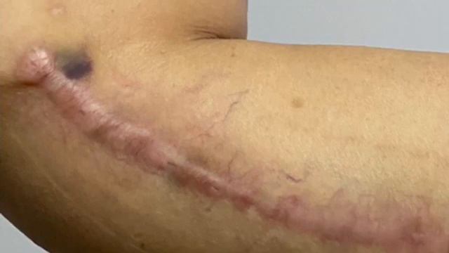 Plastic surgery HORRORS:Dr Adam Rubinstein Miami Butcher Surgeon. poor skills, bad work, ugly scars смотреть онлайн