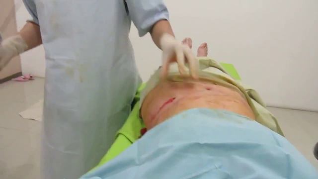 Липоксация живота и др. смотреть онлайн