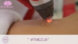 Процедура фракционного фототермолиза. Лазер Фраксель