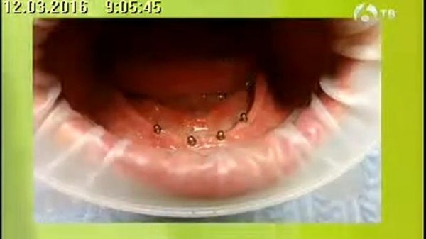 Применение мини имплантов при протезировании