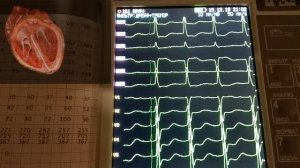 ПАРОКСИЗМАЛЬНАЯ ПРЕДСЕРДНАЯ ТАХИКАРДИЯ