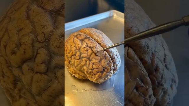 Infections On the Human Brain смотреть онлайн