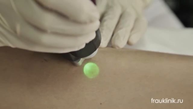 Лазерная эпиляция 'FRAU KLINIK' смотреть онлайн