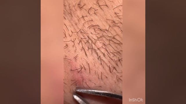 Мерзость, вросший волос подмышкой, прыщи, гной. смотреть онлайн