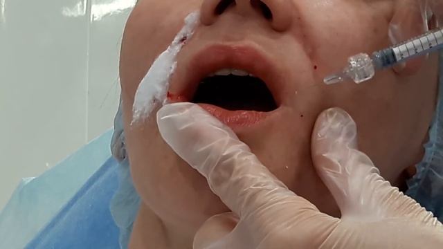 Аириском студенты учатся Применение филлеров средняя часть лица НОСОГУБНЫЕ складки морщины МАРИОНЕТ