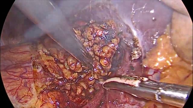 Адреналэктомия справа кровотечение смотреть онлайн