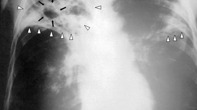 Tuberculosis | Wikipedia audio article смотреть онлайн