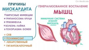 Миокардит