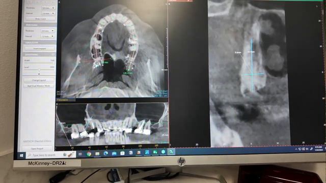 *Explicit* Step-by-Step All-on-4 Surgery: Expert Techniques Revealed. Pterygoid, Trans Sinus смотреть онлайн