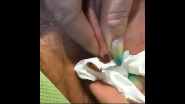 Pimple Popping Compilation 5 Most Popular Best Pimple Popping/ ВЫДАВЛИВАНИЕ ОГРОМНЫЕ ПРЫЩИ и УГРИ
