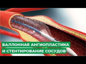 Баллонная ангиопластика и стентирование сосудов