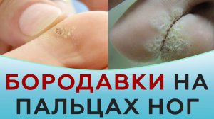 Бородавки на пальцах ног.