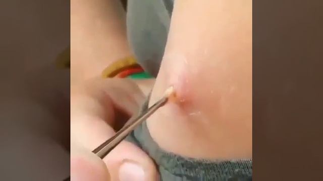 Удаление личинки овода из руки .Жесть