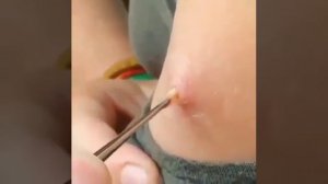 Удаление личинки овода из руки .Жесть