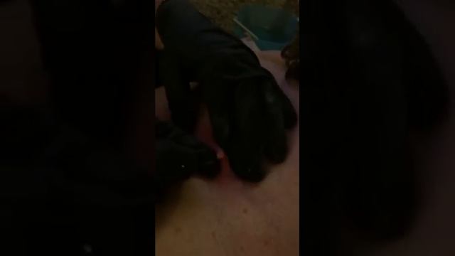 УДАЛЕНИЕ ПРЫЩА НА СПИНЕ смотреть онлайн
