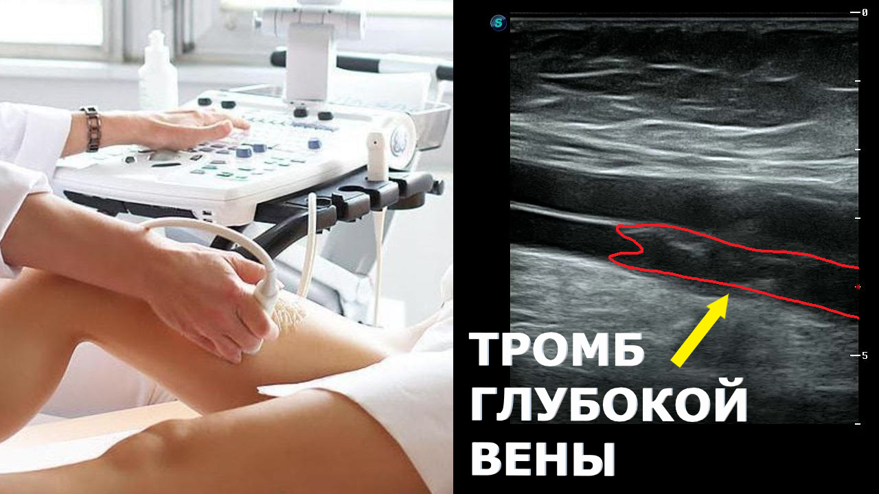 Тромбоз ГЛУБОКИХ вен нижней конечности на УЗИ смотреть онлайн