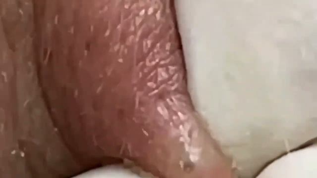 Выдавливание прыщей. Чистка лица. Акне. Прыщи смотреть онлайн