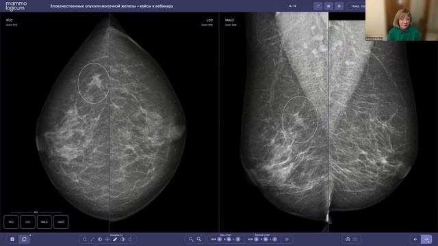 Вебинар "Злокачественные опухоли молочной железы. Что, где и как?" смотреть онлайн