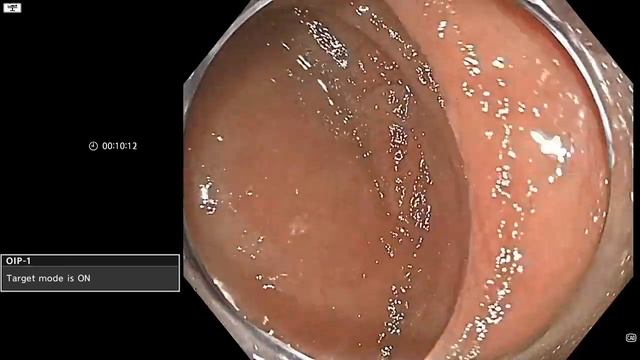 Small Adenoma Detection with AI - Olympus ENDOAID Target Mode and NBI смотреть онлайн