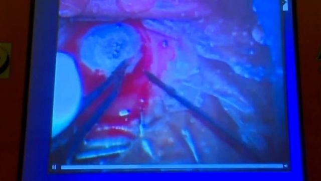 AIOC2018 - IC251- Topic - Voriconazole v/s natamycin in the management of fungal keratitis .. смотреть онлайн