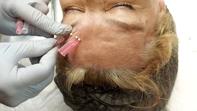 4.04 Нити межбровная область.