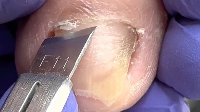 Inlay nail treatment procedure, paronychia, professional pedicure【Doctor Liu Pedicure】 смотреть онлайн