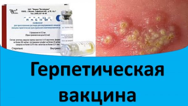 Герпетическая вакцина. Лечение герпеса.