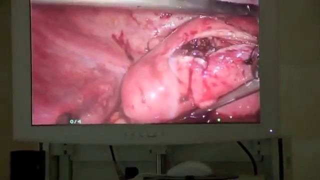 Ушивание раны после миомэктомии при помощи троакара VECTEC