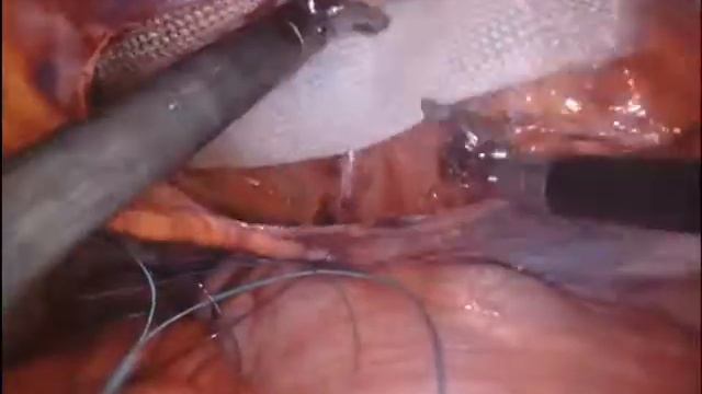 Robotic bilateral inguinal hernia repair with mesh by Dr. Iraniha смотреть онлайн