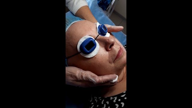 Шлифование рубца смотреть онлайн