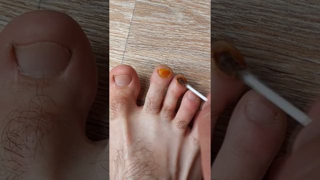 Как избавиться от грибка на ногах. Полезный лайфхак смотреть онлайн