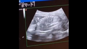 Узнали пол ребенка | УЗИ 18 неделя | Что видно на скрининге второго триместра? 18-21 неделя