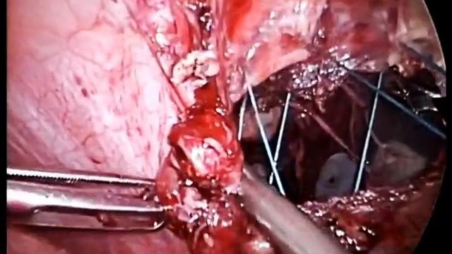 Laparoscopic Morgani Hernia Repair - Dr Matar смотреть онлайн