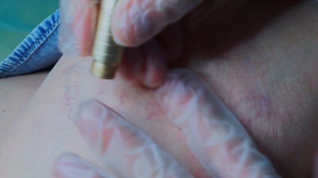 Как Удалить Сосудистые Звездочки На Ногах смотреть онлайн
